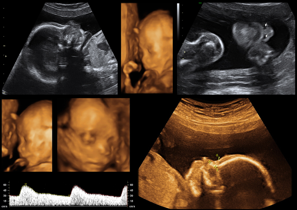 3D ultrasound of baby